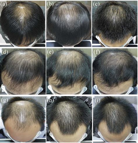 finasteride results after 6 months